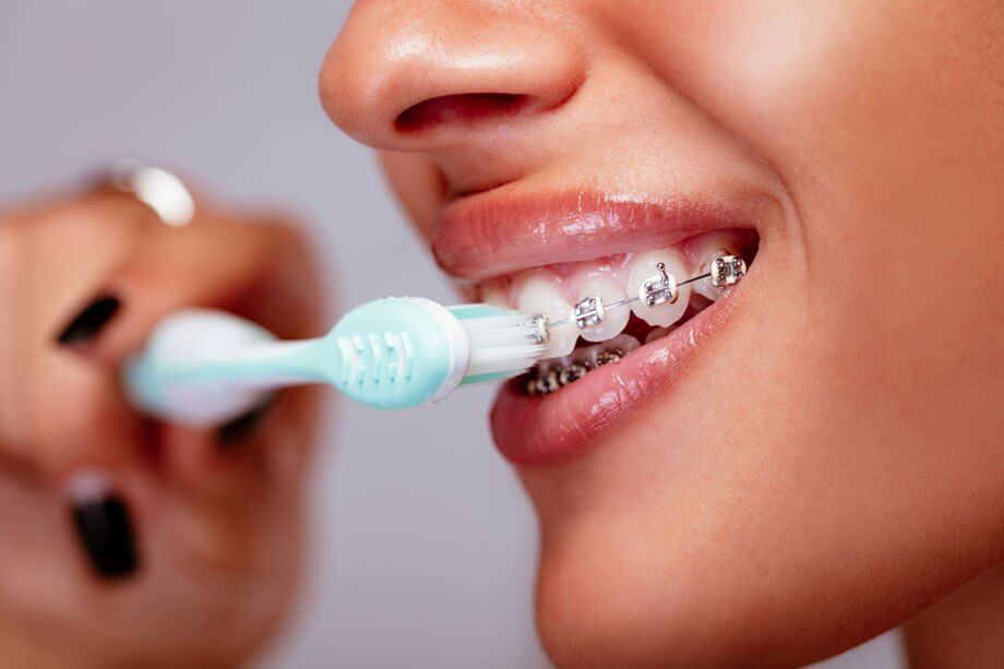 What Happens When You Don't Brush Your Teeth with Braces?