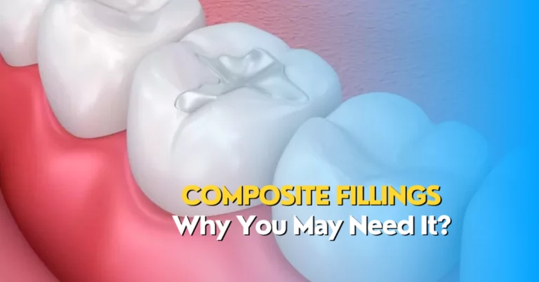 Composite Fillings: Why You May Need It?
