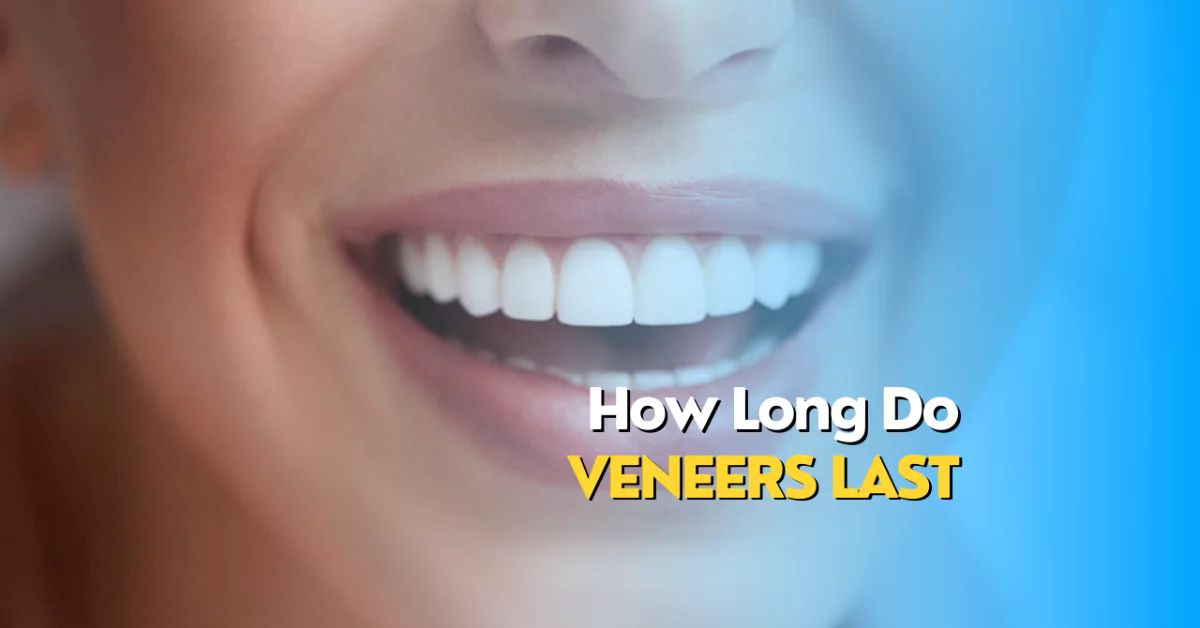 How Long Do Veneers Last