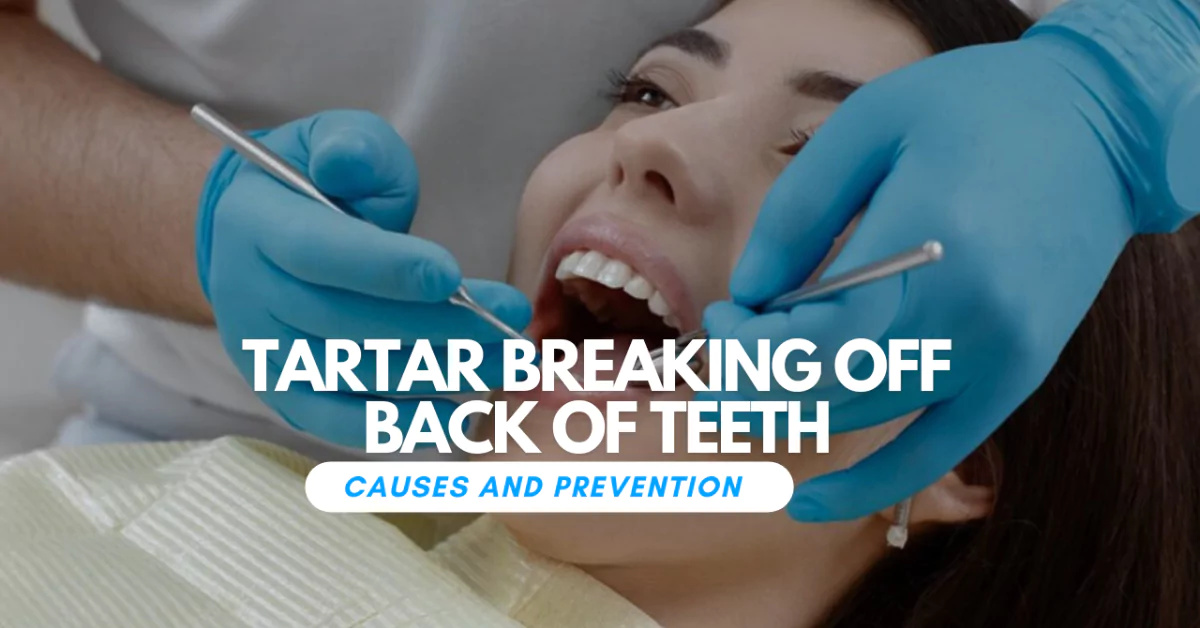Tartar Breaking Off Back of Teeth