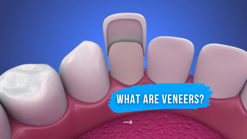 What are Veneers